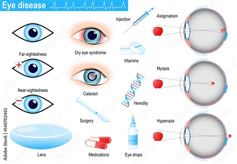 Human Eye Diseases And Disorders Infographic Stock Vector Adobe Stock