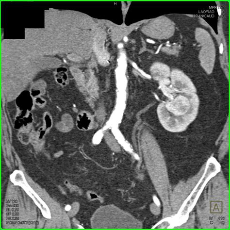 Metastatic Renal Cell Carcinoma With Pancreatic Metastases And