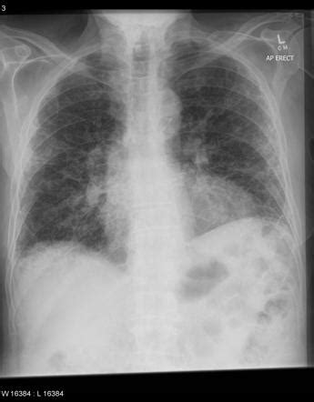 Usual Interstitial Pneumonia Radiology Reference Article