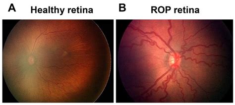 Retinopathy Of Prematurity