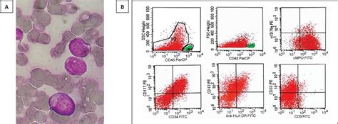 Figure 1 From Runx1runx1t1 Fusion In Pediatric Acute Myeloid Leukemia