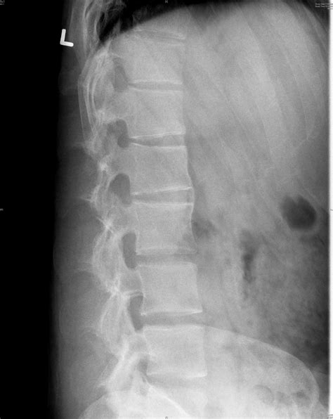 Spondylitis, Ankylosing; Ankylosing Spondylitis; Bechterew Disease ...