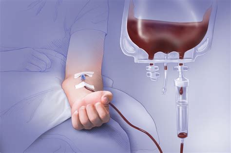 Plasma Sanguin Transfusion Transfusion Sanguine Fiche Technique Ide