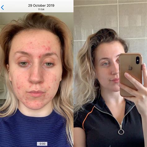 Before And After 1 Month 20mg 6 Months 40mg R Accutane