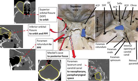 Imaging Spectrum Of Cavernous Sinus Lesions With Histopathologic Correlation Radiographics