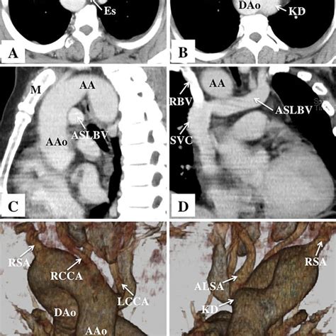 Figure1chest X Ray Findings The Widened Superior Mediastinum Is Download Scientific Diagram