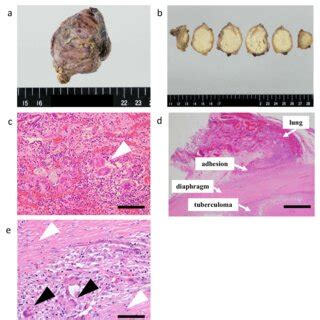 Macroscopic Findings And Histopathological Findings A B Mass In The