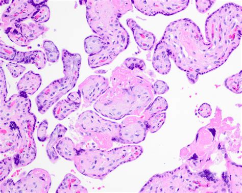 Pathology Outlines Intrauterine Fetal Demise