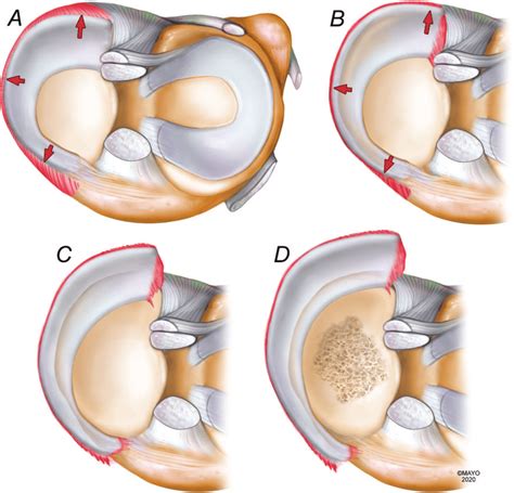 Illustration Of The Proposed Progression Of Meniscal Extrusion To A Download Scientific Diagram