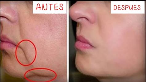 Quita las Arrugas de tu boca en 3 Días Remedio Casero para reducir