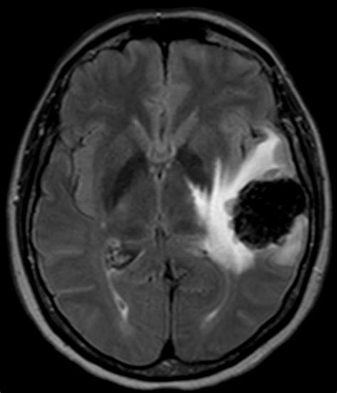 Mri Fluid Attenuated Inversion Recovery Flair Sequence Download Scientific Diagram