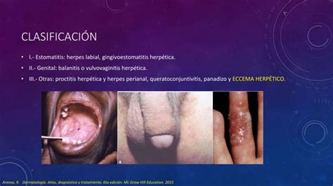 Varicela Virus Herpes Zóster Y Varicela Zóster Ppt