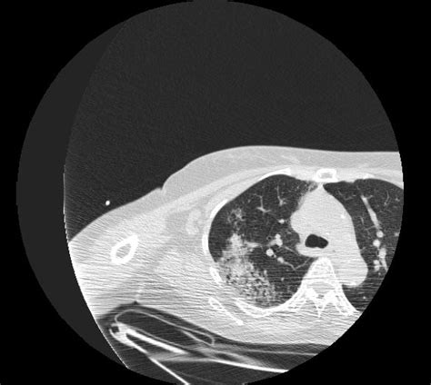 Pulmonary hemorrhage - wikidoc