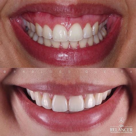 Odontologia em Dicas Dentista on Instagram Correção do sorriso