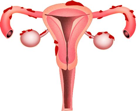 Seek Natural Endometriosis Treatment To Improve Fertility Aim Womens