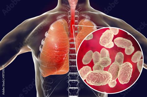 Whooping cough bacteria Bordetella pertussis in human airways Stock ...