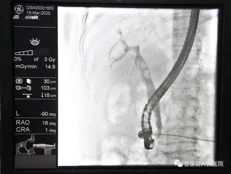 不开刀取胆总管结石——我院消化内科成功开展首例ercpest手术 苍溪县人民医院 官方网站