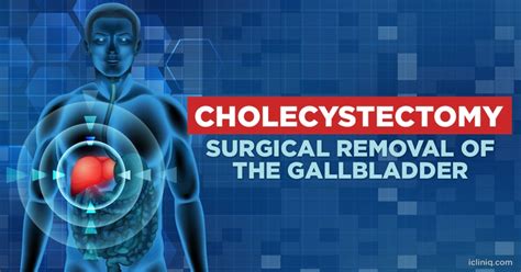 Cholecystectomy - Surgical Removal of the Gallbladder