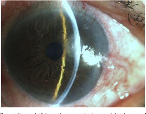 Figure 1 From Candida Parapsilosis Keratitis Treated Successfully With Topical And Oral