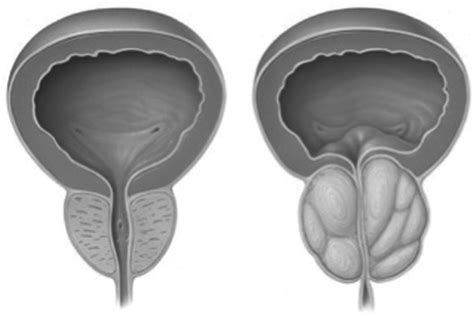 Jle Sexologies Lhyperplasie B Nigne De La Prostate