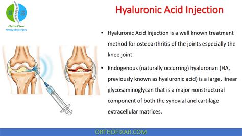 Hyaluronic Acid Injection Orthofixar 2024