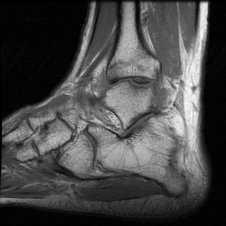 Talar Dome Osteochondral Injury With Detached Fragment Image