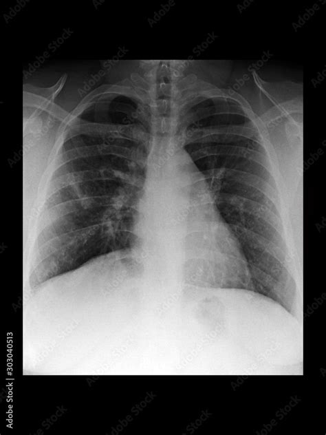 Atelectasis Chest X Ray