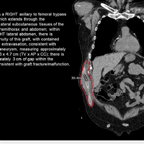 CT Angiogram Showing Graft Fracture With Pseudoaneurysm And Active