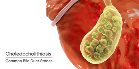 What Are Common Bile Duct Stones Choledocholithiasis Chennai Laser