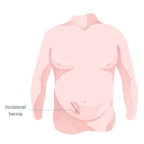 Incisional Hernia Surgery Sydney Dr Mark Magdy