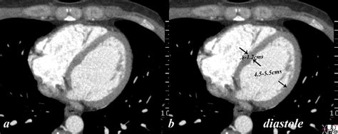 Left Ventricle Lv Size And Ct Heart