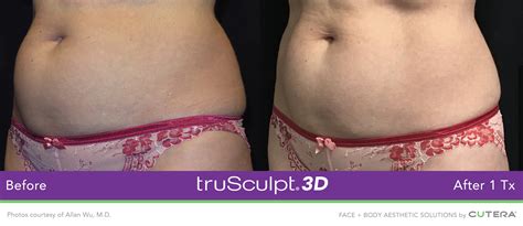 Trusculpt Non Surgical Fat Reduction Cincinnati And Springboro