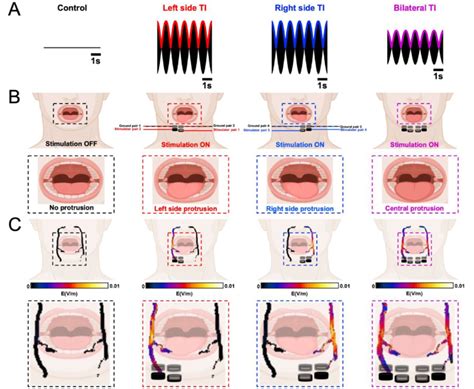 Bilateral hypoglossal nerve stimulation reduces stimulation amplitudes ...