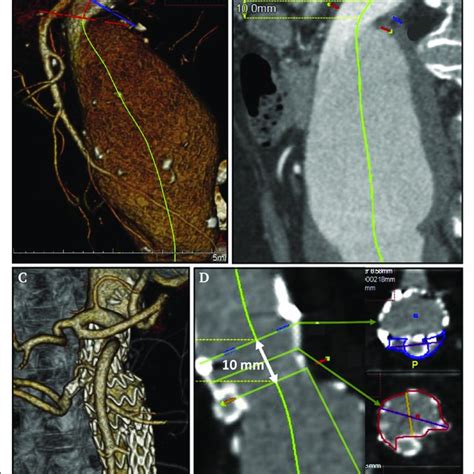 Example Case Of Pararenal Aortic Aneurysm Treated By Chimney Download Scientific Diagram