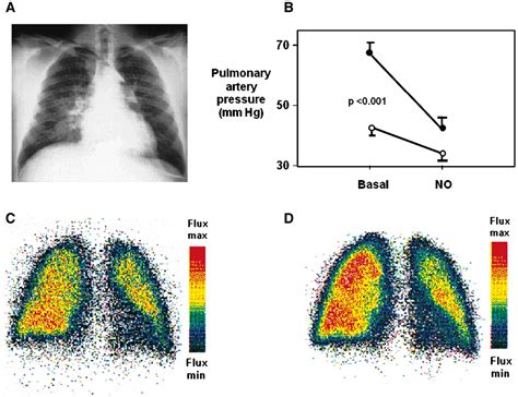 Figure From New Insights In The Pathogenesis Of High Altitude