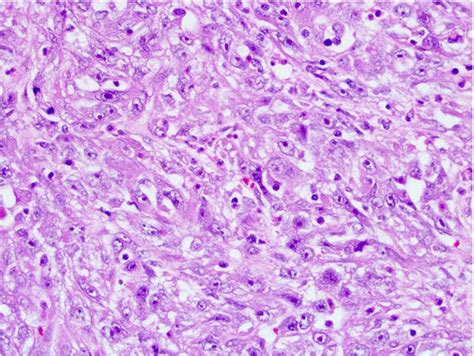 Pathology Outlines Collecting Duct Carcinoma