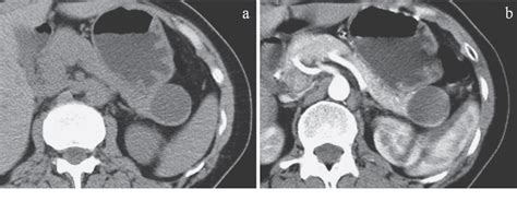 Figure 1 From Epithelial Cyst Arising In An Intrapancreatic Accessory Spleen A Diagnostic