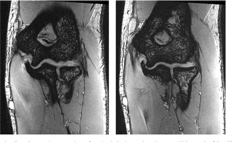 Figure 2 From Hypertrophy Of The Sublime Tubercle In Elbow Ulnar Collateral Ligament Injuries A