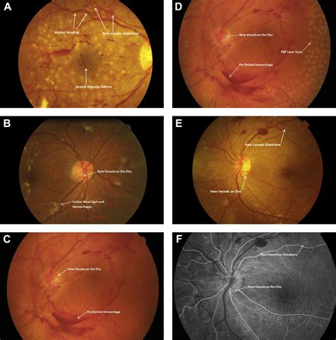 Guidelines On Diabetic Eye Care Ophthalmology