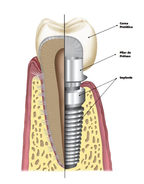 Partes do implante dentário