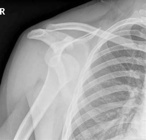 56-year-old Male has Right Shoulder Hemiarthroplasty Due to Undiagnosed Re-Dislocation ...