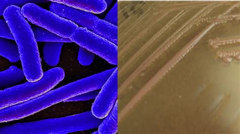 Enteroinvasive E Coli Eiec Transmission Disease Pathogenesis