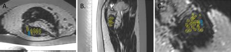 Frontiers Case Report Desmoid Tumor Response To Magnetic Resonance