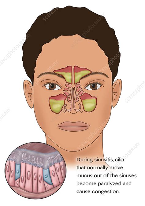 Sinusitis Illustration Stock Image C0366319 Science Photo Library