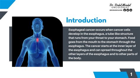 Ppt Things To Know About Esophageal Cancer Powerpoint Presentation Free Download Id12189762