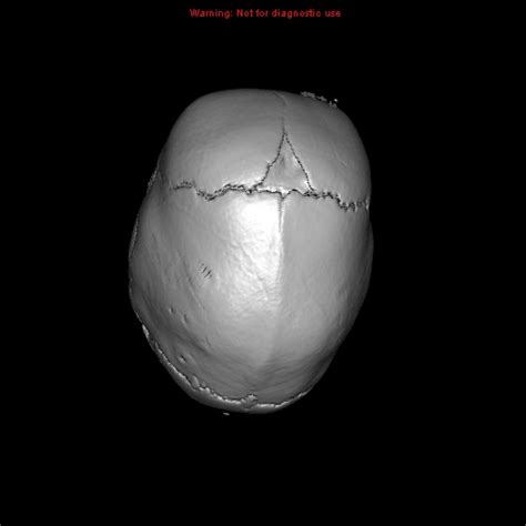 Scaphocephaly | Image | Radiopaedia.org