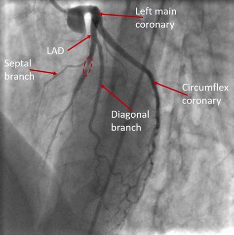 Coronary artery stenosis - left anterior descending | Radiology Case ...