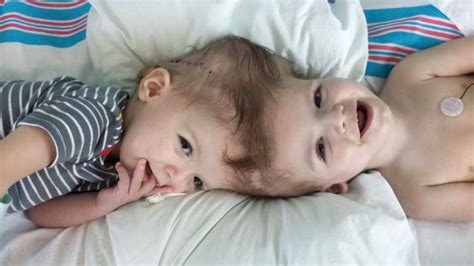 Shared Triumphs Unveiling The Miraculous Lives Of Conjoined Twins