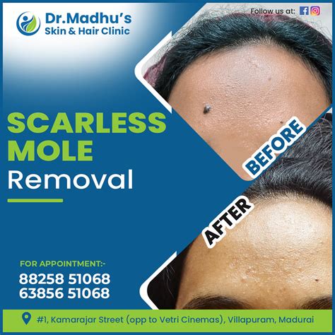 Scarless Mole Removal Petchimuthu M Flickr