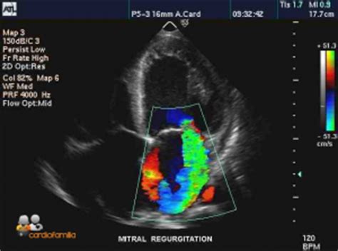 Estenosis Mitral por Noelia Saura Celdrán